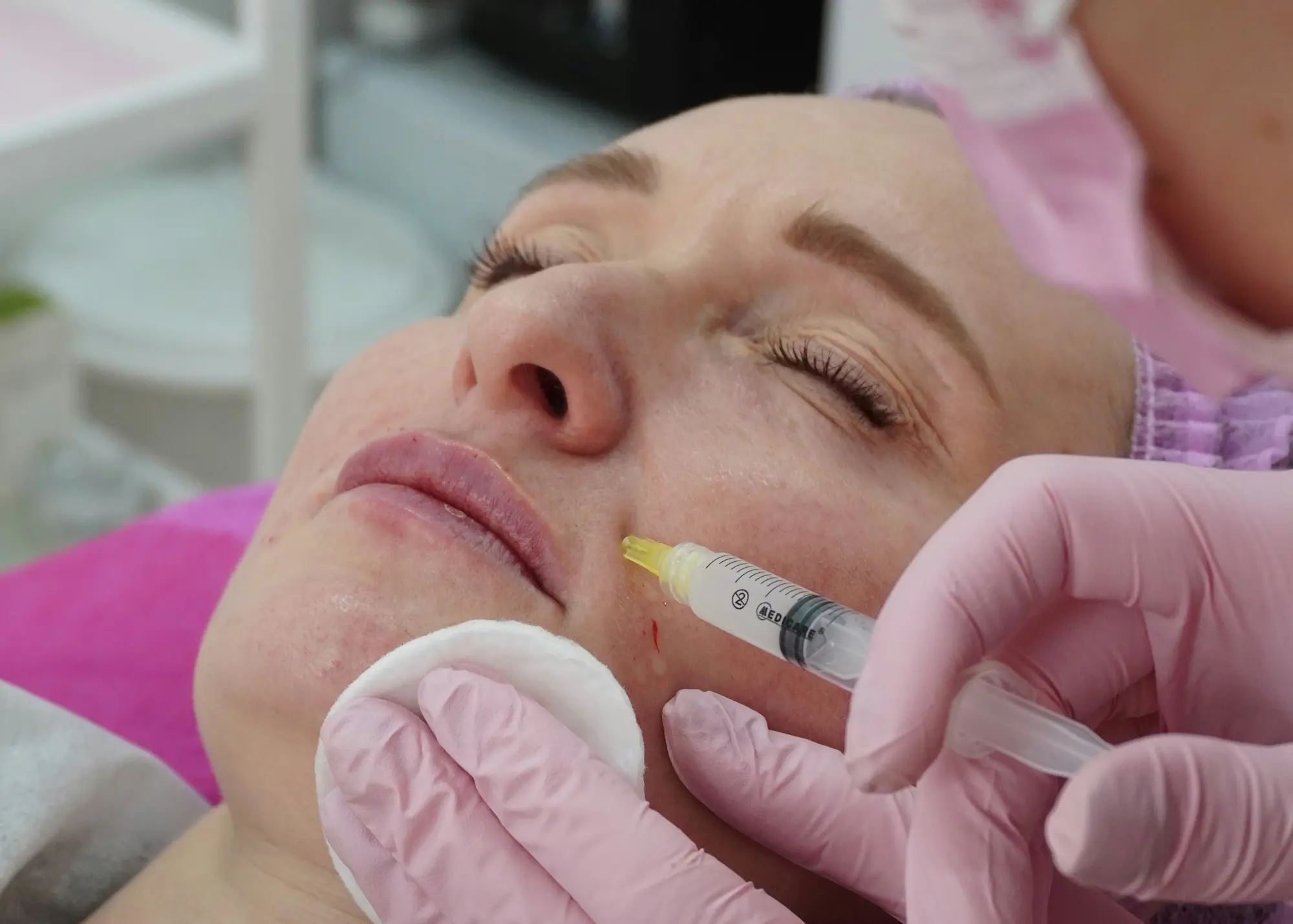 Dermal filler treatment illustration